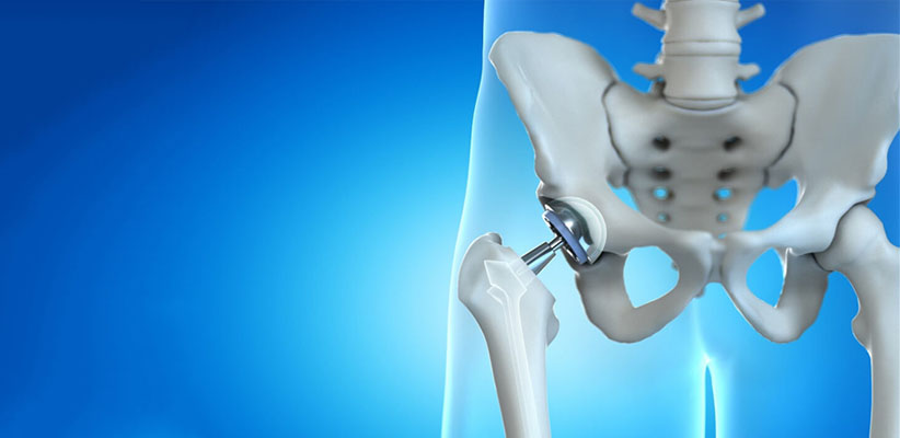 Hip Replacement Surgeon in Ahmedabad, Gujarat