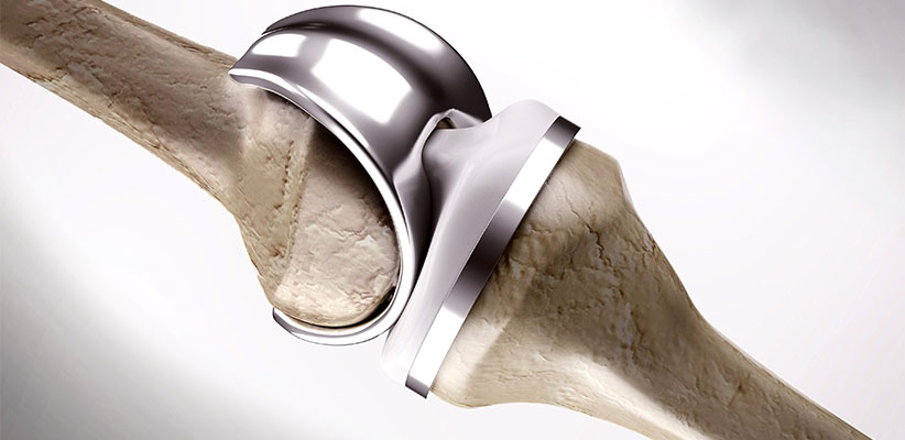 Total Knee Replacement in Ahmedabad Total Knee Replacement in Ahmedabad, Gujarat